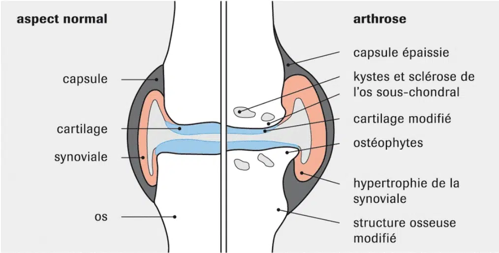 Schéma cartilage sain et arthrose